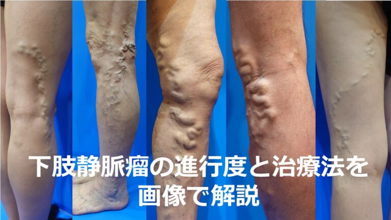 足の血管がボコボコ浮き出る原因と受診目安 | 下肢静脈瘤のすべて | 症状・治療・予防がわかる総合情報サイト