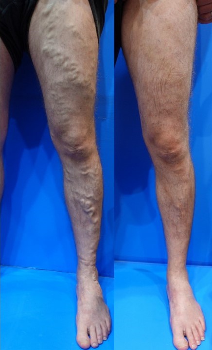 下肢静脈瘤ビフォーアフター写真