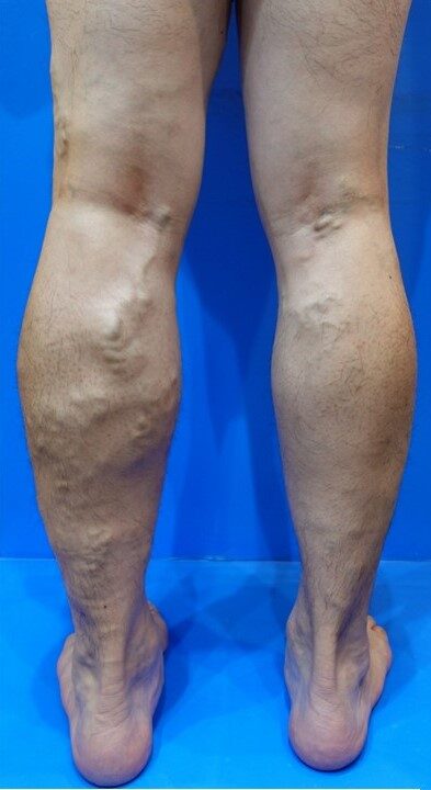 下肢静脈瘤ビフォー写真